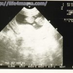 妊娠10週目のエコー画像