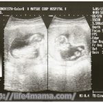 妊娠13週目のエコー画像