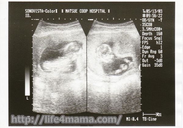 妊娠13週目のエコー画像