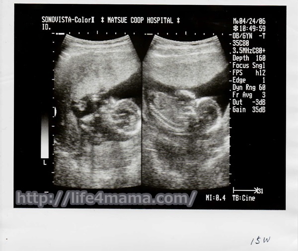 妊娠15週目のエコー画像