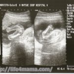 妊娠18週目のエコー画像