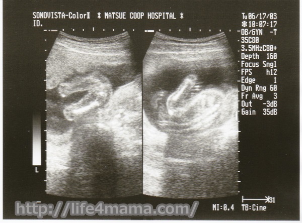妊娠18週目のエコー画像