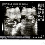 妊娠19週目のエコー画像