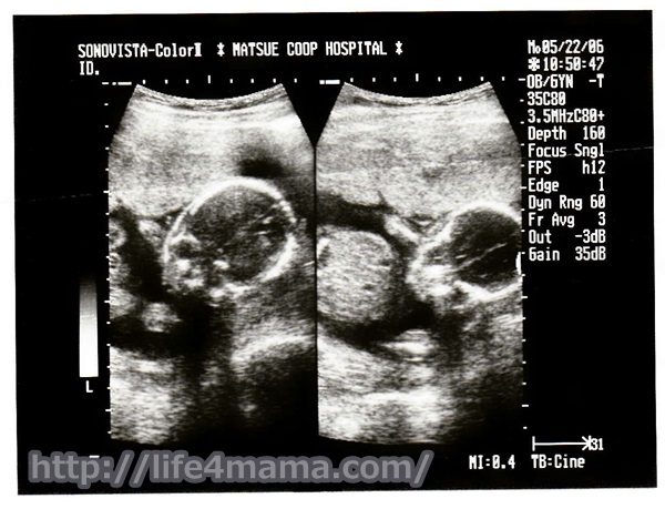 妊娠19週目のエコー画像