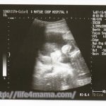 妊娠22週目のエコー画像