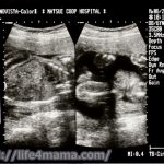 妊娠24週目のエコー画像