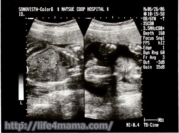 妊娠24週目のエコー画像