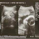 妊娠26週目のエコー画像