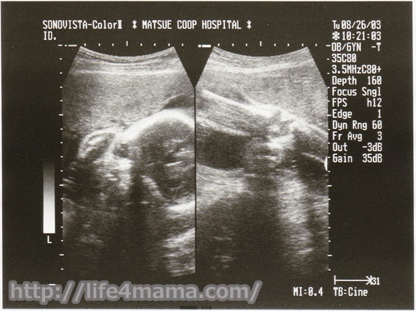 妊娠28週目のエコー画像