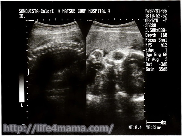 妊娠29週目のエコー画像