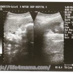 妊娠30週目のエコー画像