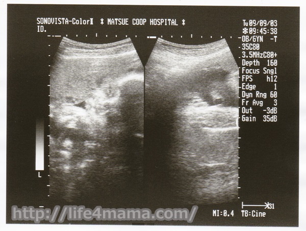 妊娠30週目のエコー画像