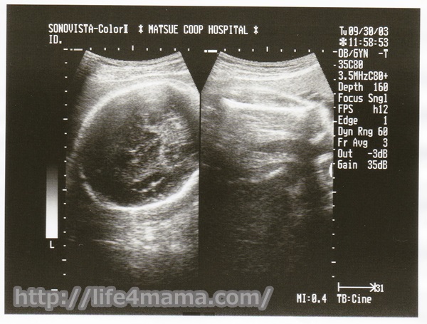 妊娠33週目のエコー画像