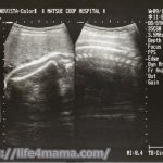 妊娠35週目のエコー画像