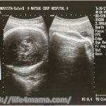 妊娠36週目のエコー画像
