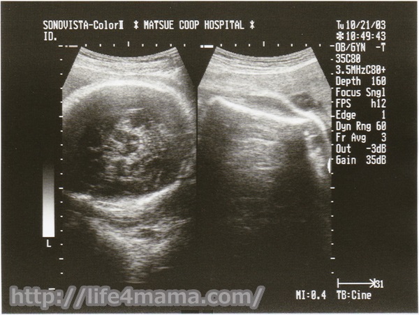 妊娠36週目のエコー画像