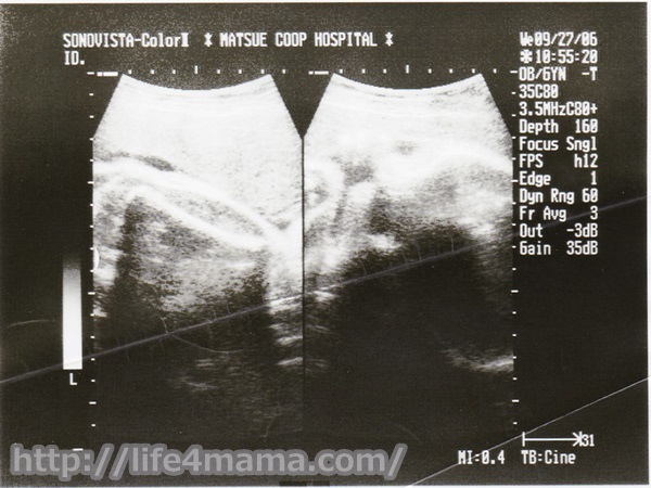 妊娠37週目のエコー画像