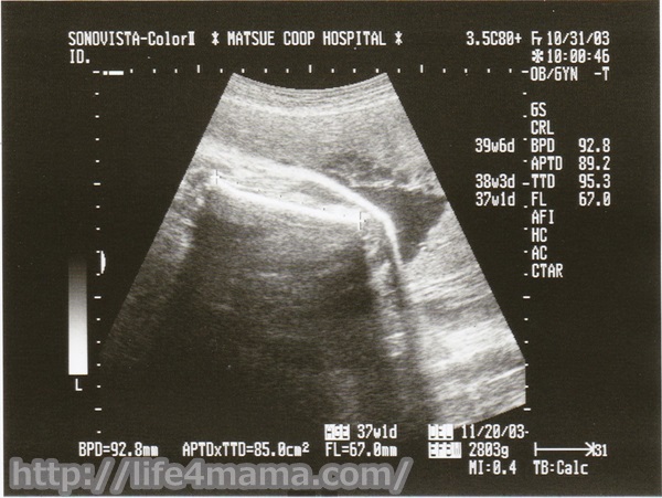 妊娠38週目のエコー画像