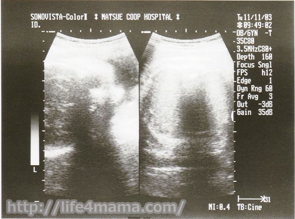 妊娠39週目のエコー画像