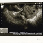 妊娠6週目のエコー画像