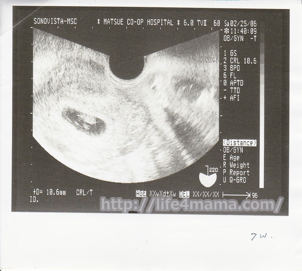 妊娠7週目のエコー画像